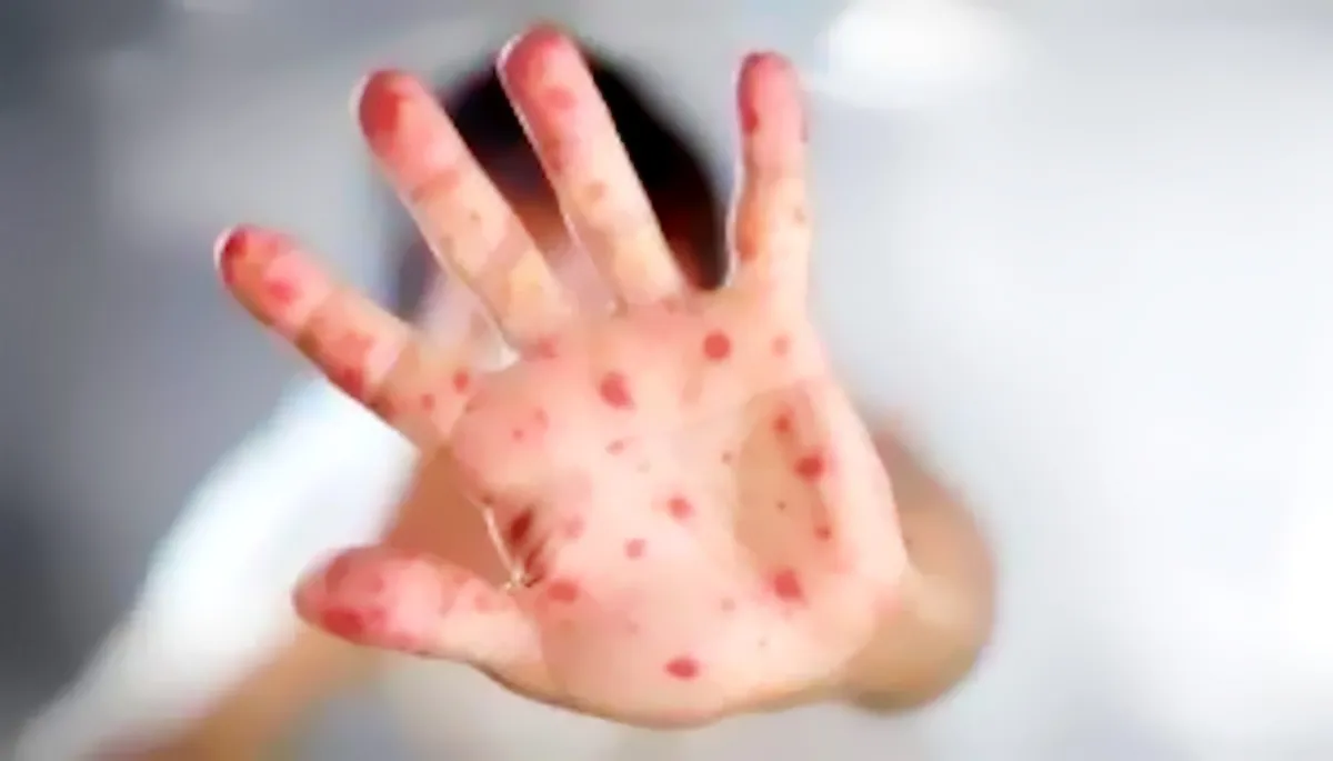 Crescita esponenziale dei casi di morbillo nell’UE/SEE nel 2024: un campanello d’allarme per la sanità pubblica